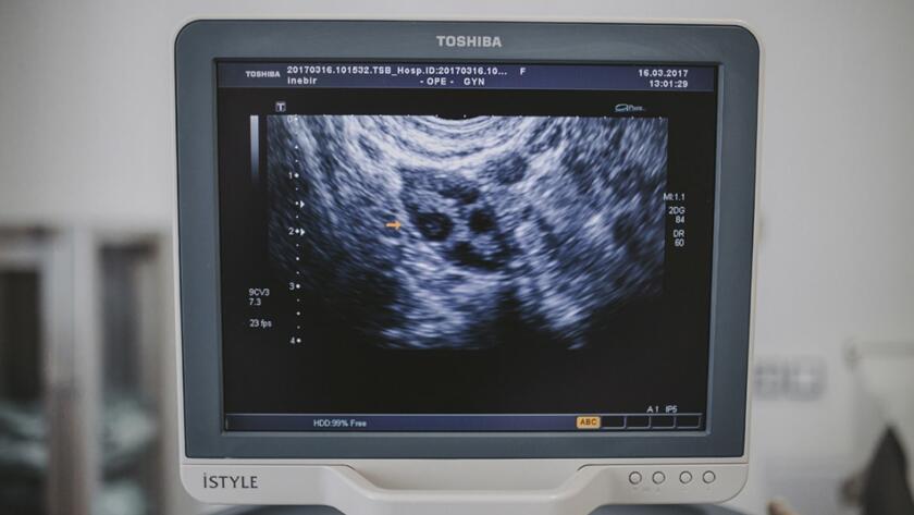 endometriosi a Napoli