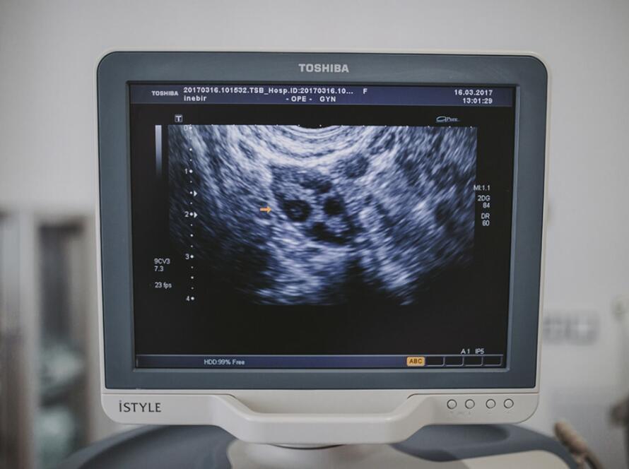 endometriosi a Napoli