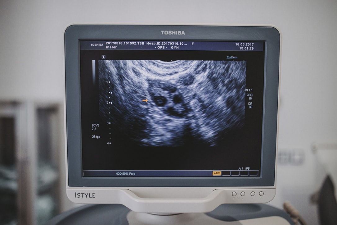 endometriosi a Napoli
