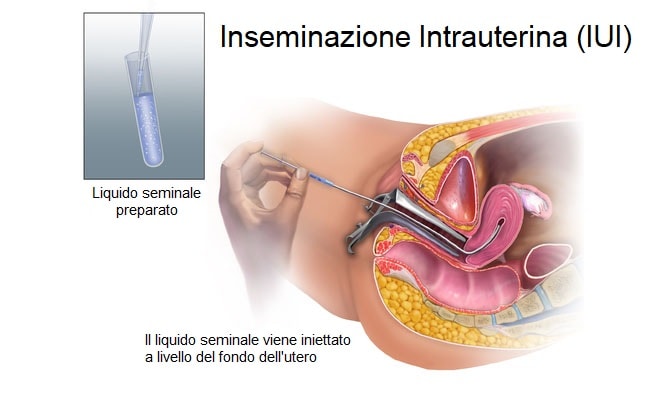 fecondazione assistita Salerno
