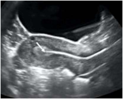 Singolo embryo transfer