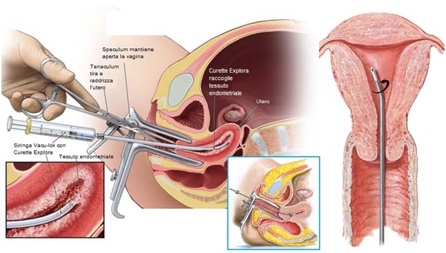scratching endometriale