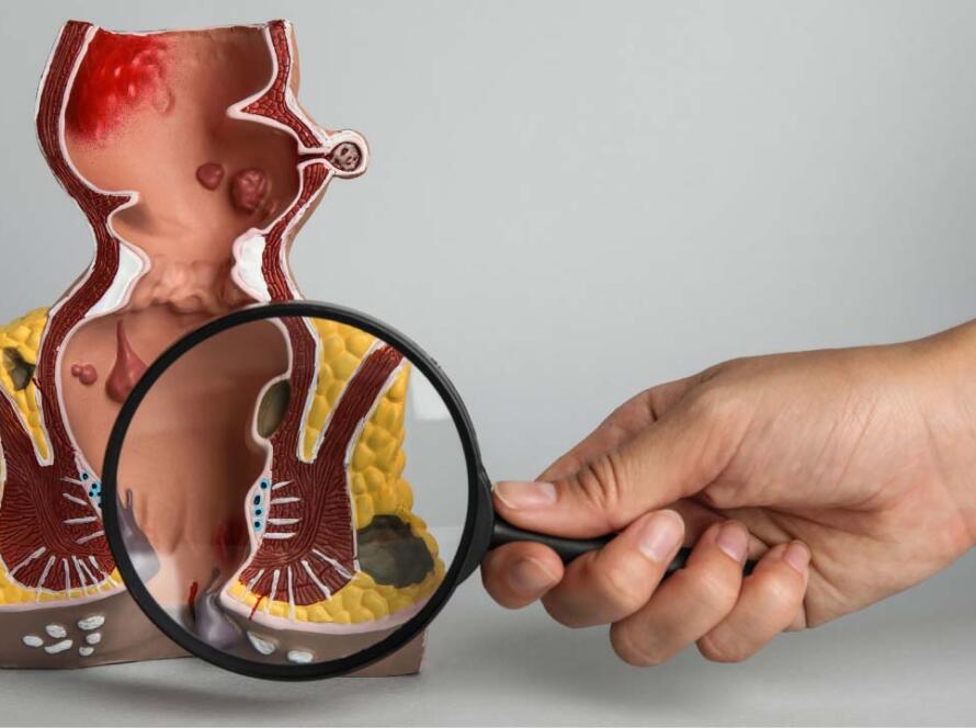varicocele e infertilità maschile a Napoli