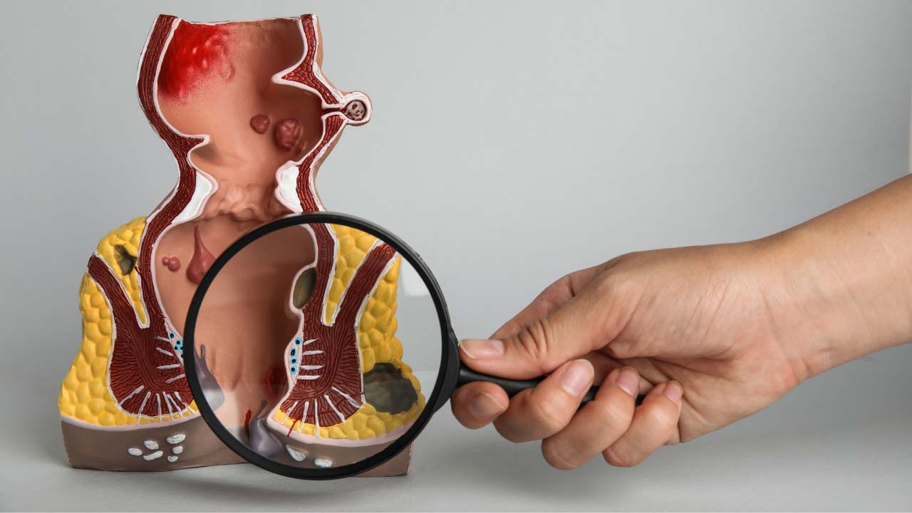 varicocele e infertilità maschile a Napoli