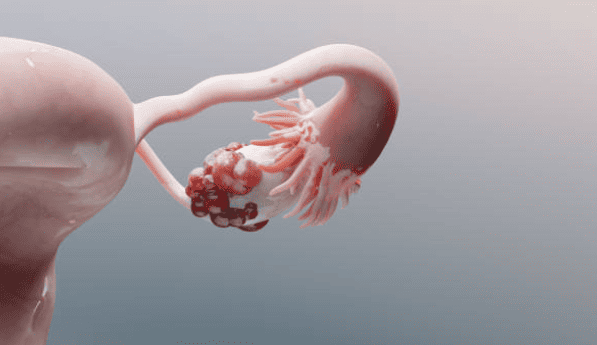 Endometriosi e infertilità Napoli